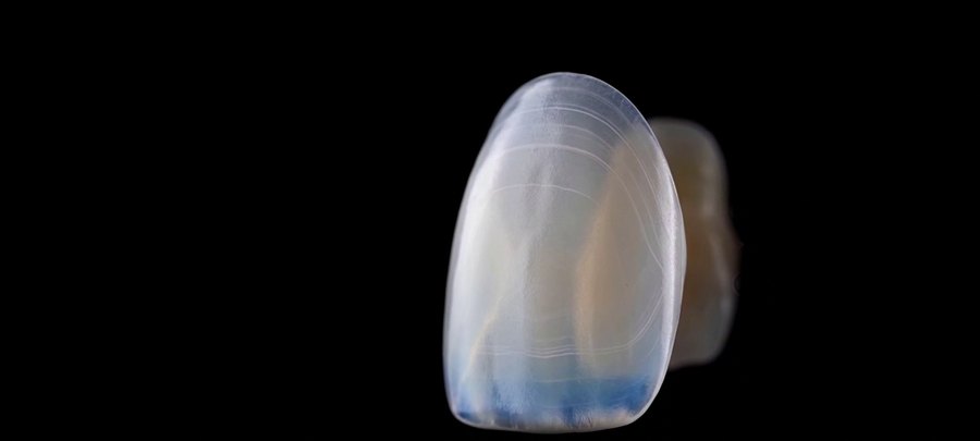 Facette en céramique, vue en gros plan