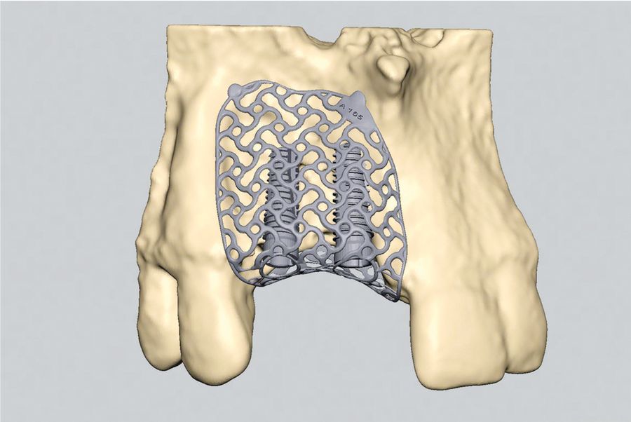 Modélisation 3D d'une grille en titane au maxillaire