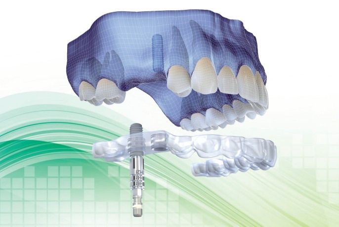 Illustration : guide chirurgical pour implant