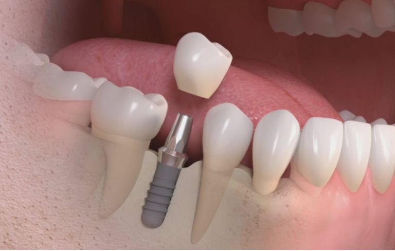 Illustration : implant dentaire et couronne