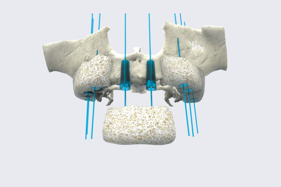 Planification 3D d'implants et de greffe
