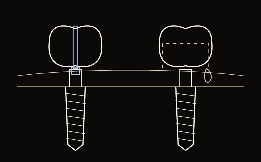 Couronne sur implant transvissée (vis accessible par un puits) et couronne scellée (ciment entre pilier et couronne) (illustration)