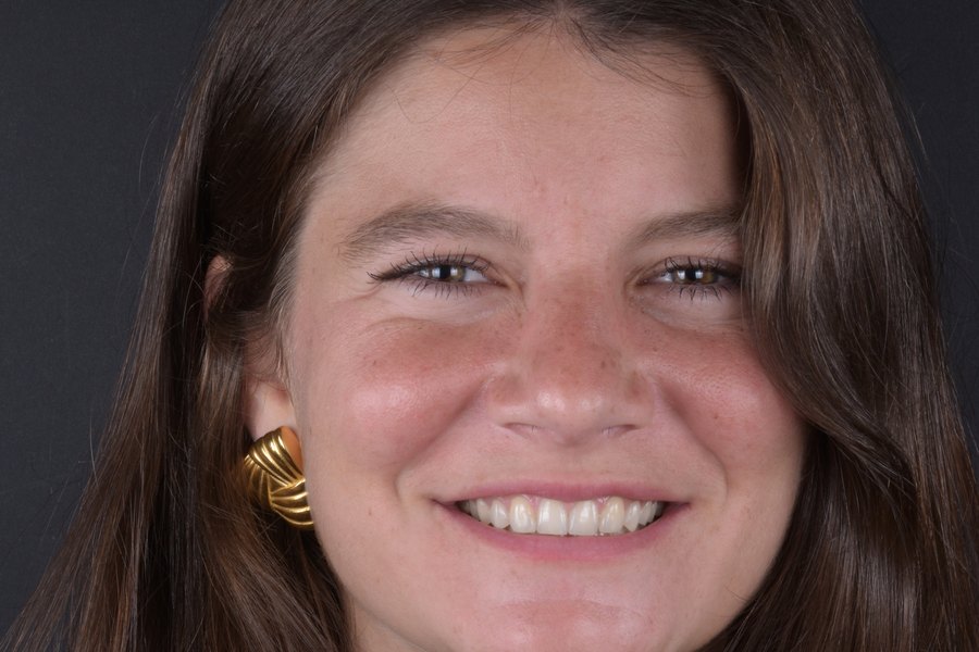 Sourire de face après traitement (patient du cabinet, accord écrit)
