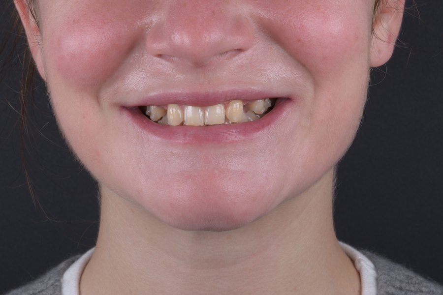 Sourire avant traitement : deux dents absentes (patient du cabinet, accord écrit)