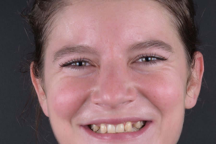 Sourire de face avant traitement (patient du cabinet, accord écrit)