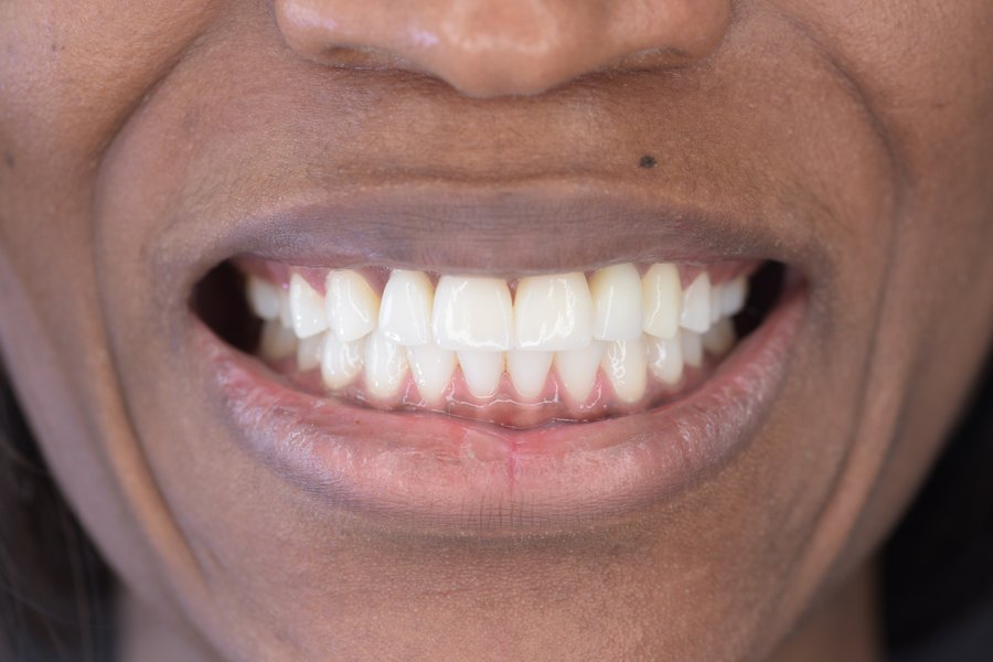 Sourire après traitement (patient du cabinet, accord écrit)