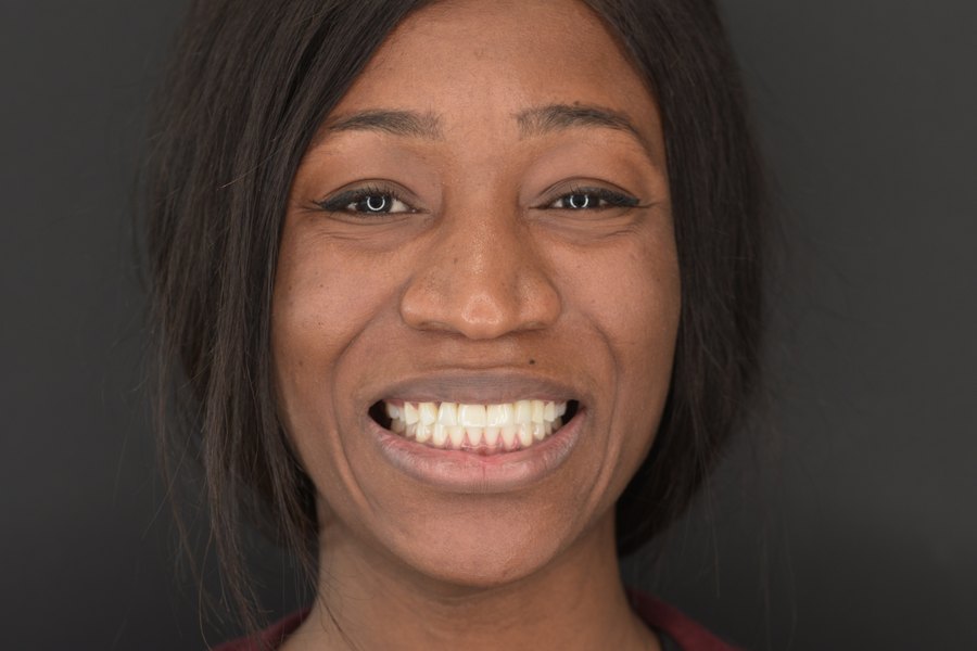 Sourire de face après traitement (patient du cabinet, accord écrit)