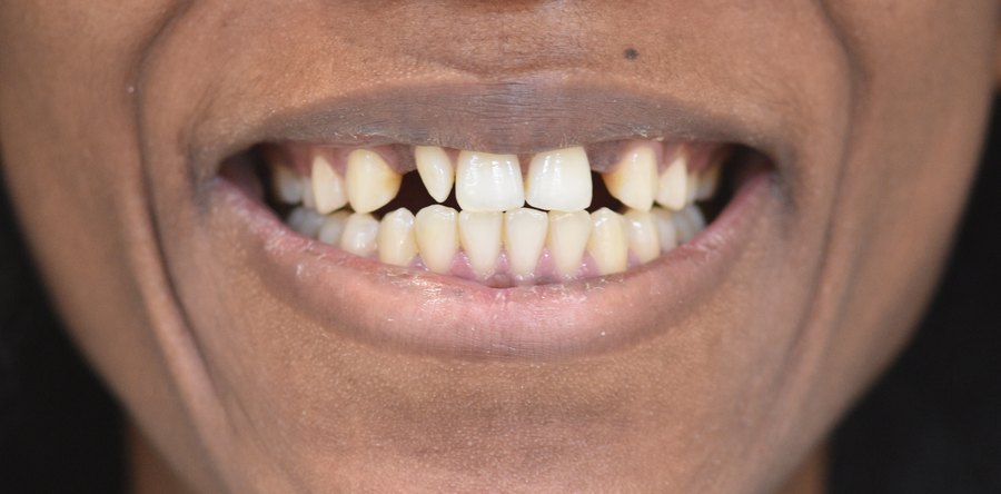 Sourire avant traitement : espaces entre les dents (patient du cabinet, accord écrit)