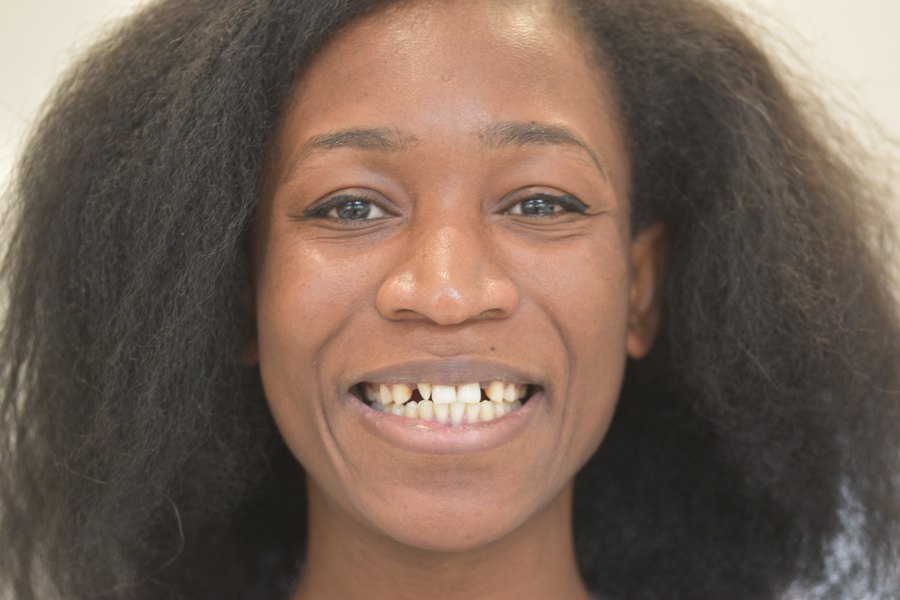 Sourire de face avant traitement (patient du cabinet, accord écrit)