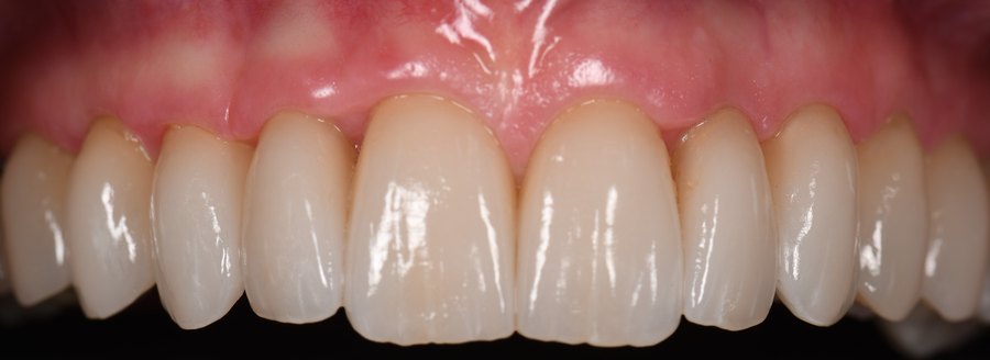Les mêmes dents après restaurations en céramique (patient du cabinet, accord écrit)