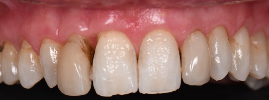 Dents antérieures colorées et abîmées avant traitement (patient du cabinet, accord écrit)