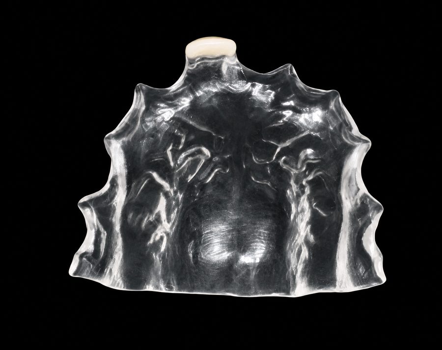Prothèse amovible pédiatrique : une plaque de résine transparente portant une incisive