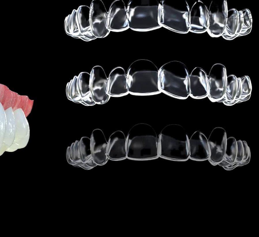 Aligneurs transparents (animation)