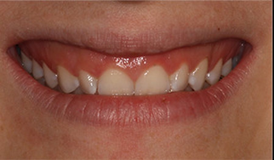 Sourire gingival avant traitement (patient du cabinet, accord écrit)
