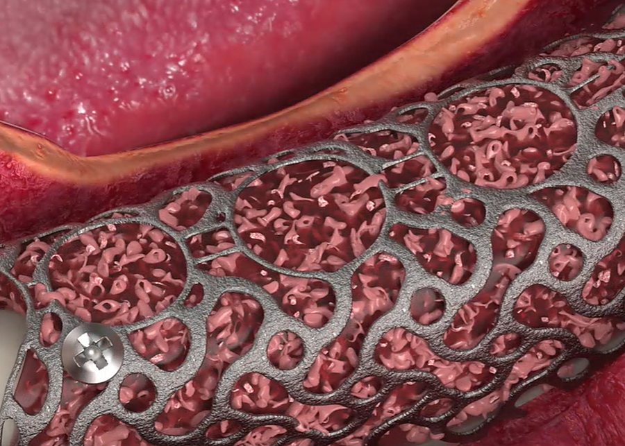 Grille en titane sur mesure et os de comblement (illustration)