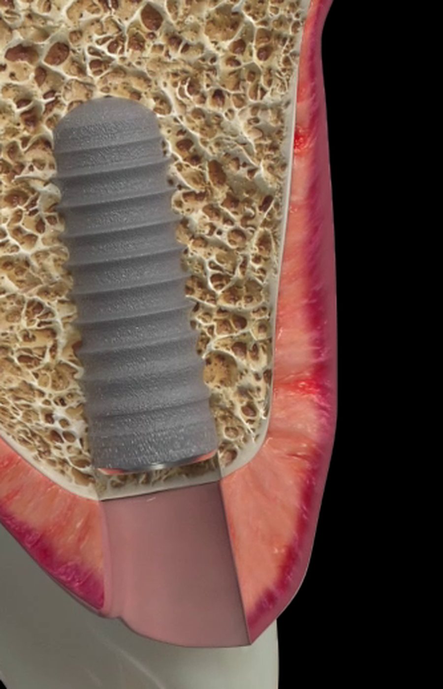 Implant dentaire dans l'os (animation)