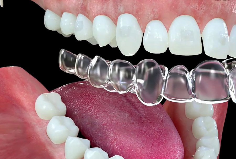 Gouttière transparente posée sur les dents (animation)