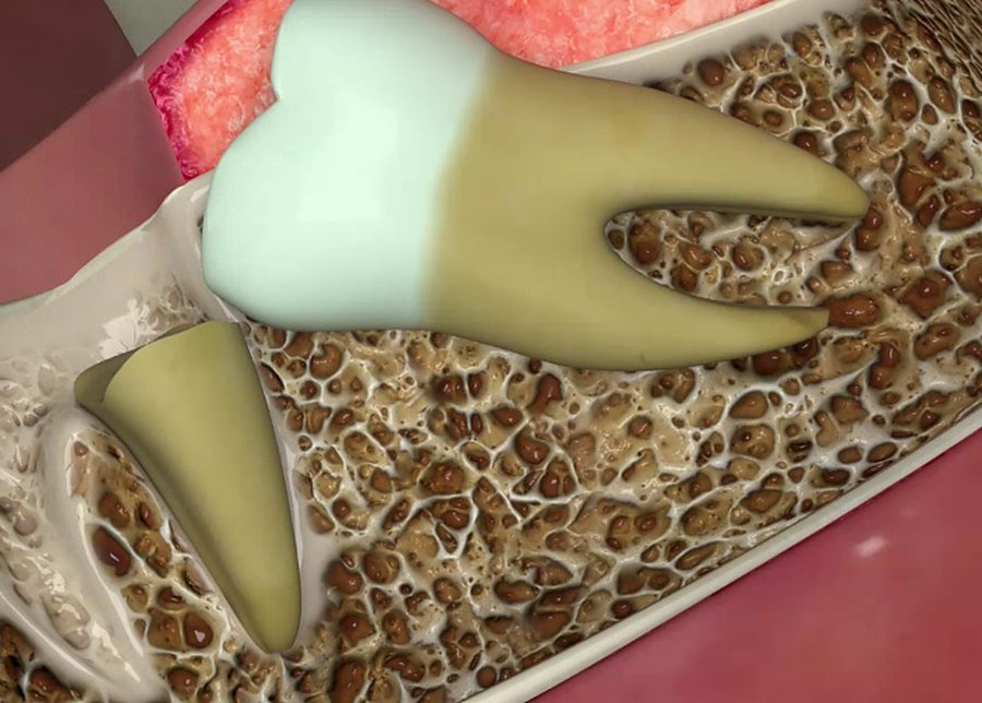 Extraction d'une dent de sagesse (animation)