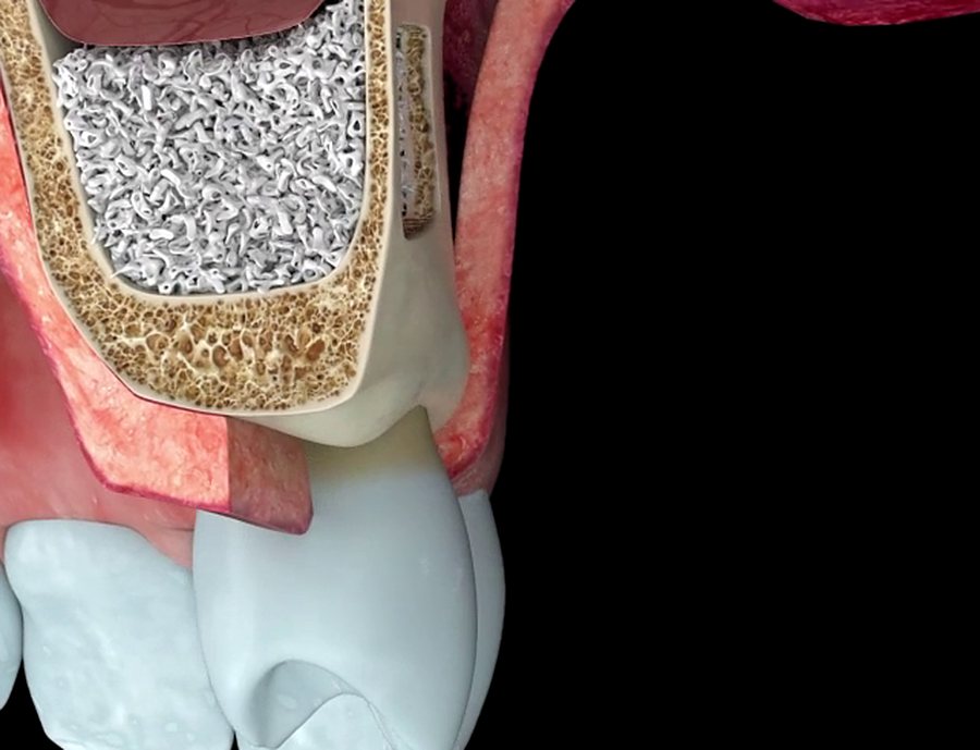 Comblement osseux du sinus (animation)