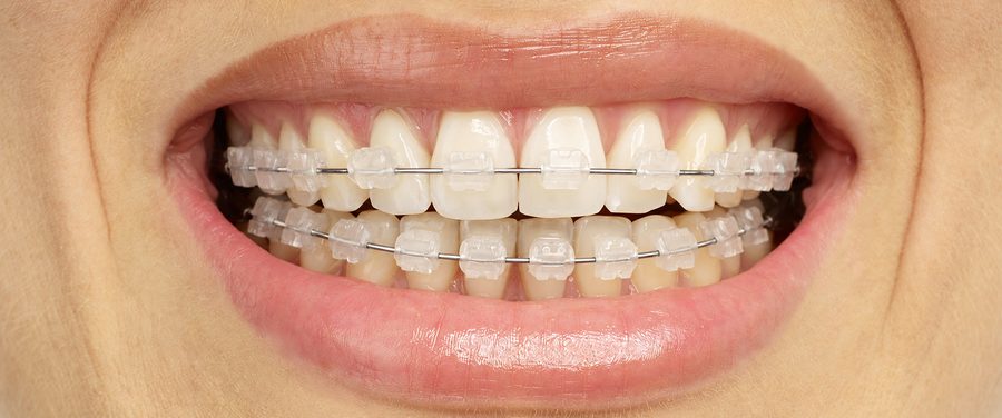 Attaches orthodontiques en céramique