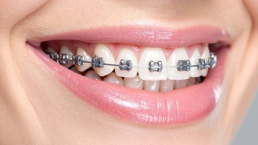Attaches orthodontiques métalliques