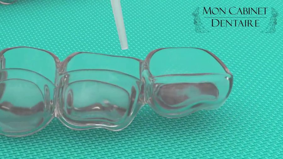 Gouttières de blanchiment et gel