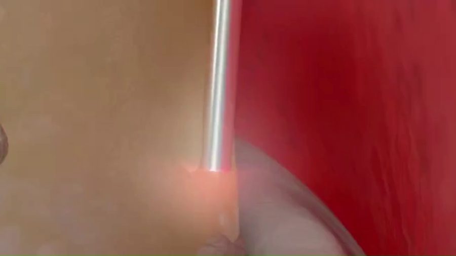 Fibre laser glissée le long de la racine, dans la poche parodontale