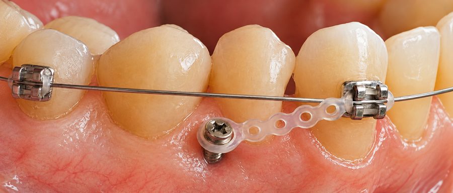 Minivis orthodontique reliée à une attache