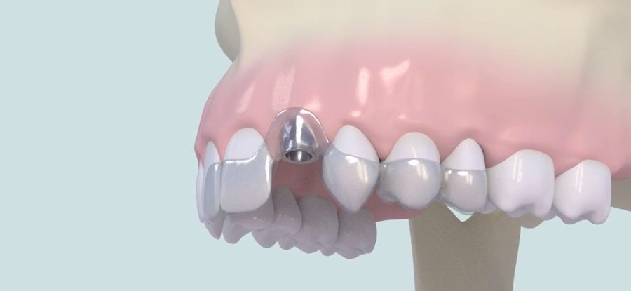 Implant et son pilier en place entre deux dents