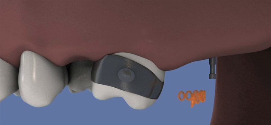 Molaire redressée à l’aide d’une minivis orthodontique