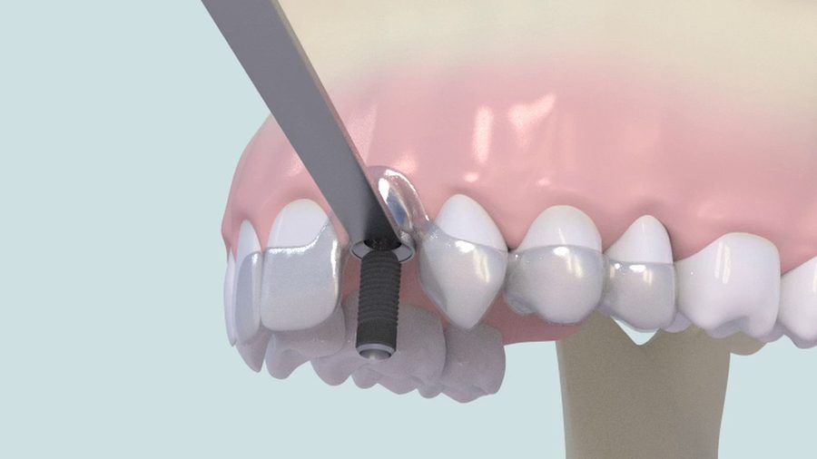 Couronne vissée sur un implant